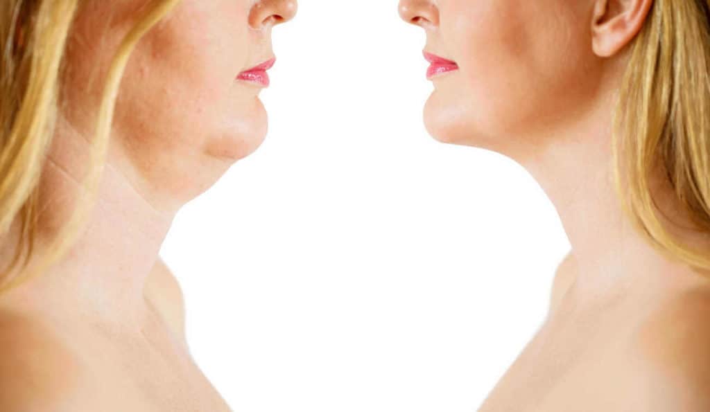 Double Chin treatment Bristol before and after results