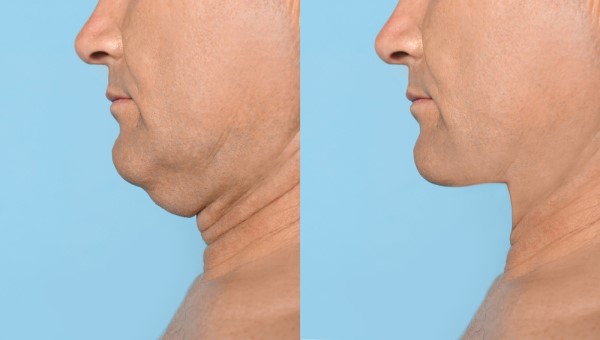 Which Non-Surgical Treatments Work Best for Jowls and Loose Skin Bristol?
