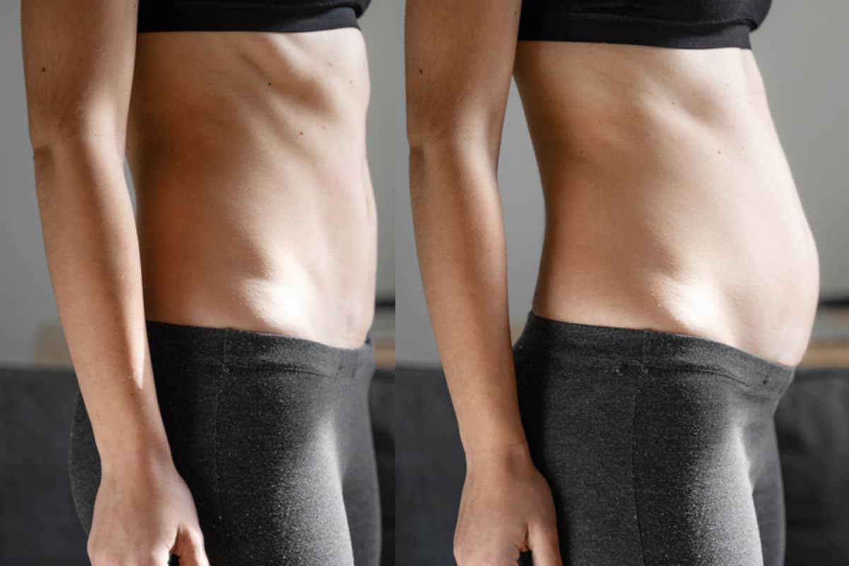 How long does diastasis recti take to improve Bristol?