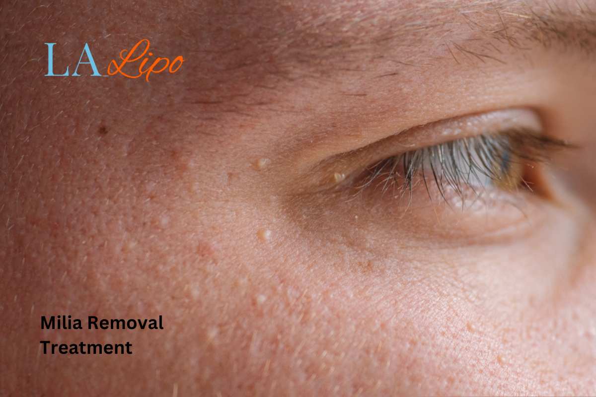 Cryopen Milia Removal: Is It the Easiest and Safest Option Bristol?