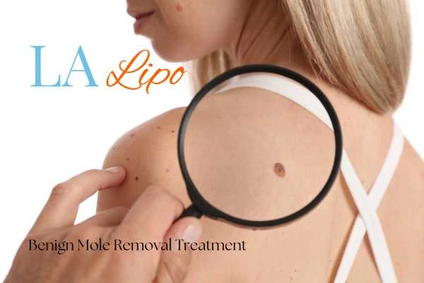 Woman having her inspection of blemish before mole removal Bristol