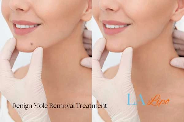 Before and after mole removal Bristol treatment