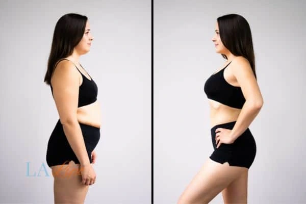image of woman before and after results of LA-EMS Body Sculpting Bristol to help treat Diastasis recti