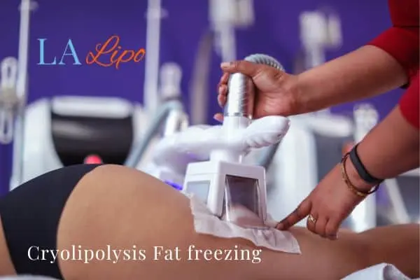 women getting fat freezing Bristol