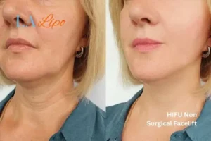 hi-fu for wrinkles Bristol before and after results