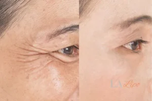 Before and after results of woman - HI-fu wrinkles reduction treatment Bristol