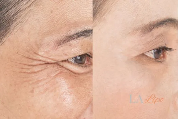 Before and after results of woman - HI-fu wrinkles reduction treatment Bristol