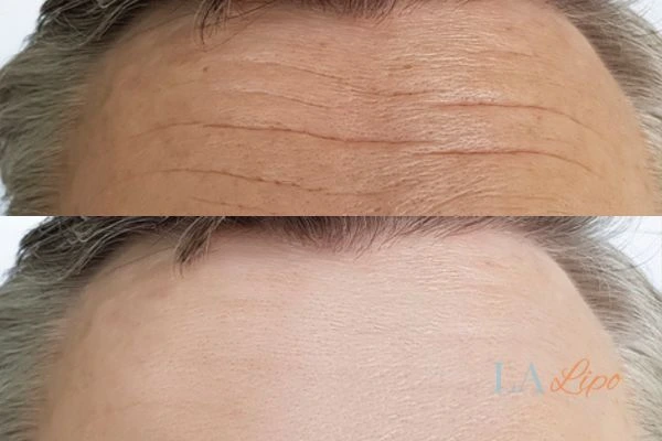 results of HIFU Bristol on mans forehead to help reduce lines and wrinkles