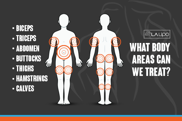 Graphic to show areas you can have LA-EMS Body Sculpting Bristol treatment.