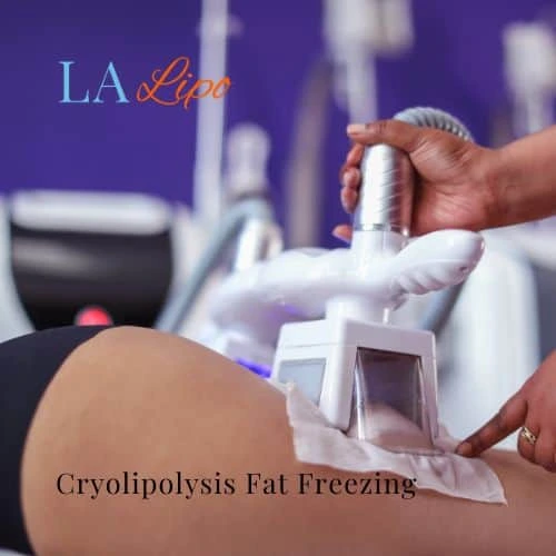 fat freezing - Cryolipolysis Bristol
