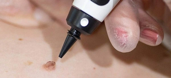 skin tag removal using cryopen Bristol
