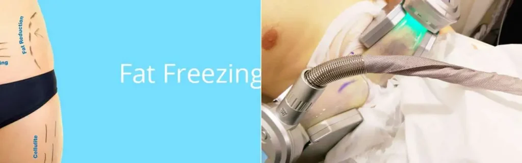 multi areas of a persons body having coolsculpting Bristol treatment