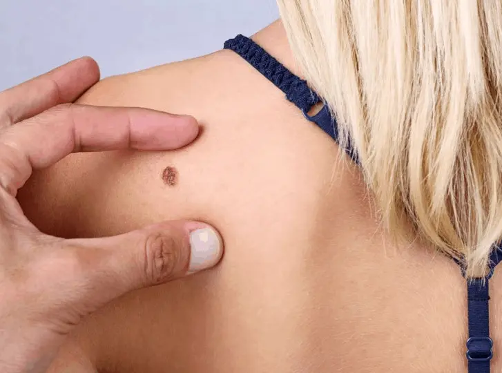 woman having mole removal Bristol consultation before treatment.