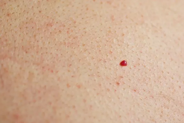 close up of a cherry angioma Bristol