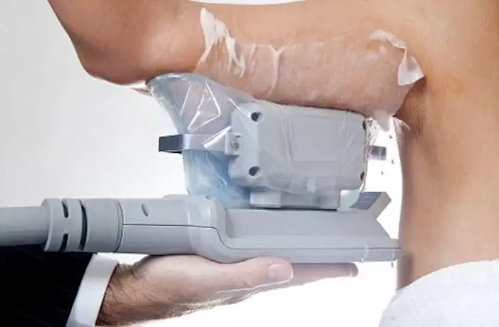 Picture of fat freezing Bristol on the upper arms.