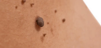 image of a skin tag Bristol