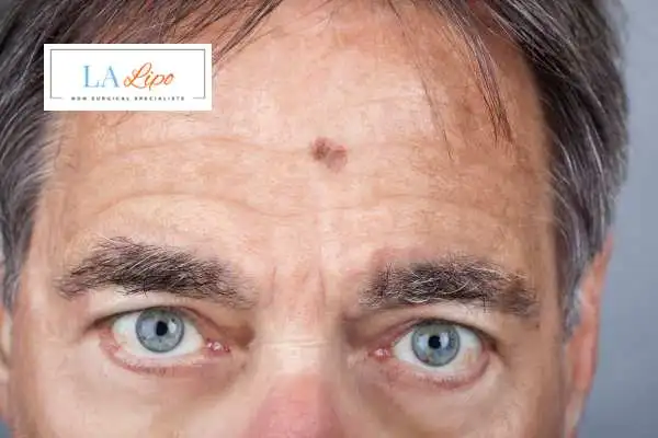 Solar Lentigo Removal Bristol image of man with mark on his forehead