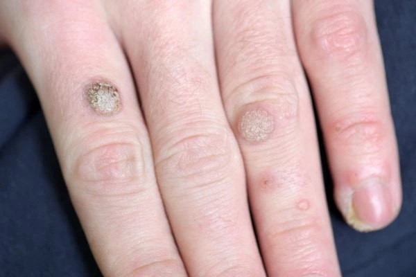 photo of warts on person hand - see wart removal Bristol from LA LIPO