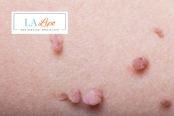 Does cryopen skin tag removal Bristol hurt? Find out now call our team today!