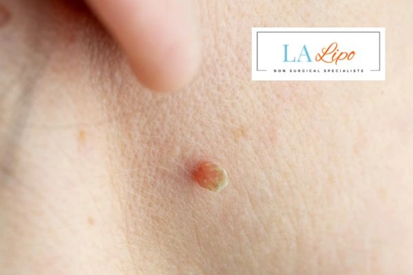 Book skin tag removal Bristol today speak to our team now!