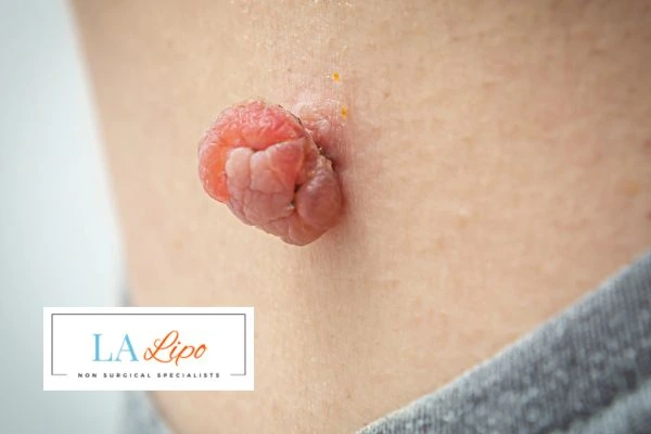 Interested in skin tag removal Bristol? Concerned about the pain? Find out more today!