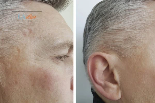 Mens Before & After Morpheus 8 Results Bristol