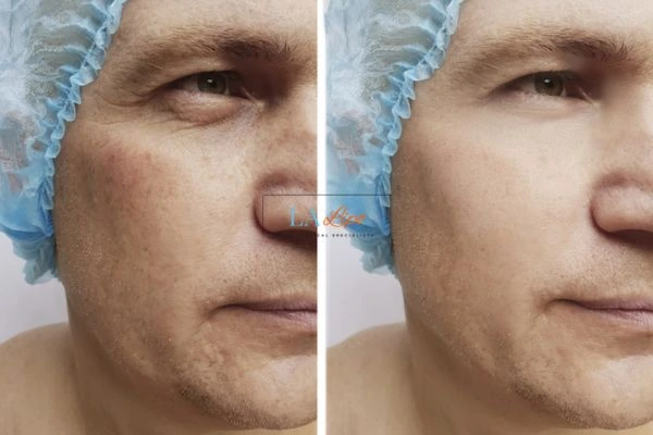 Before and after Morpheus 8 Results Bristol