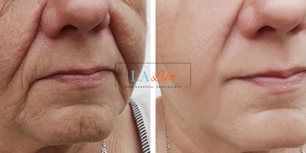 Older lady deeper wrinkle reduction - LA LIPO Morpheus 8 Results Bristol