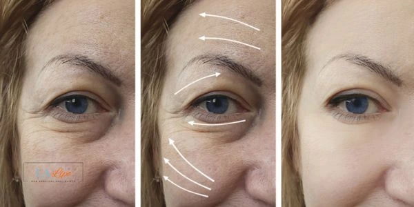 Amazing eye lift Morpheus 8 results Bristol