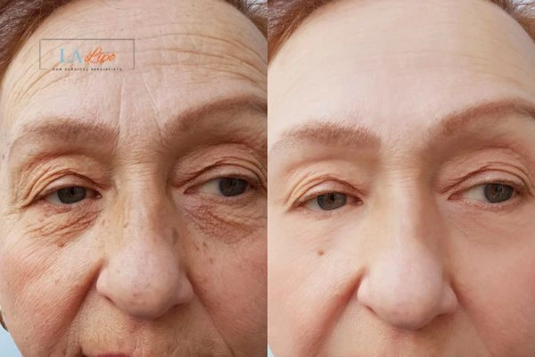 The powerful benefits of Morpheus8 Treatment Bristol - Call Our team today!