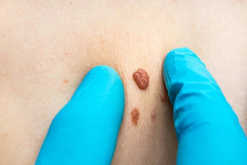 LA LIPO Cryopen Lesion Removal Prices Bristol