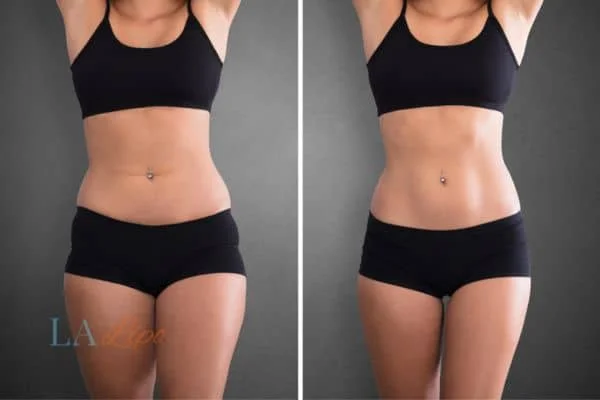 before and after results of non-surgical treatment to help a woman's body image and mental health Bristol