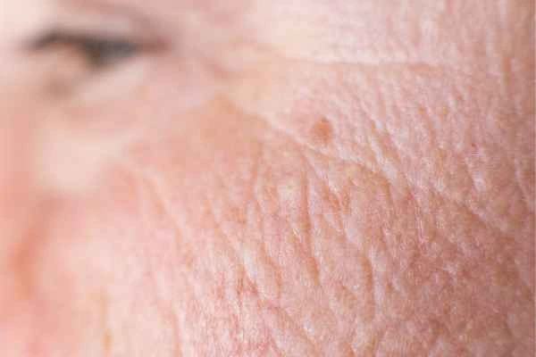 close up picture of a woman's face showing an age spot Bristol
