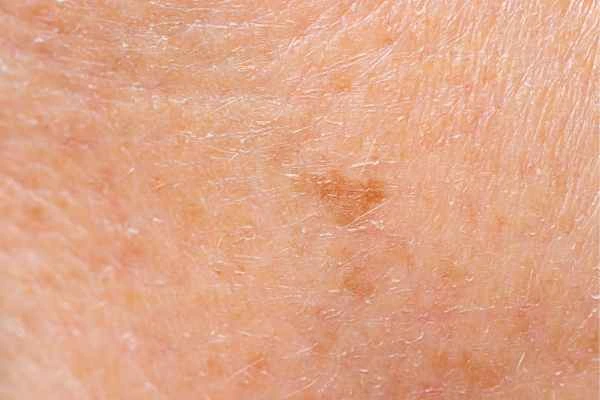 close up picture of age spots Bristol