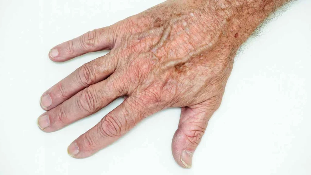 Male hand showing age spot Bristol