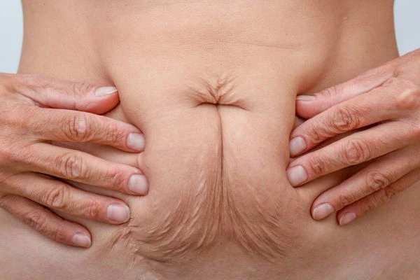Image of a woman's stomach with loose skin - example of skin tightening Bristol options