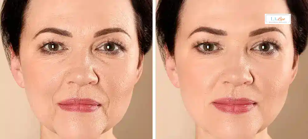 How Long Does It Take to See Results and How Long Do They Last Bristol?