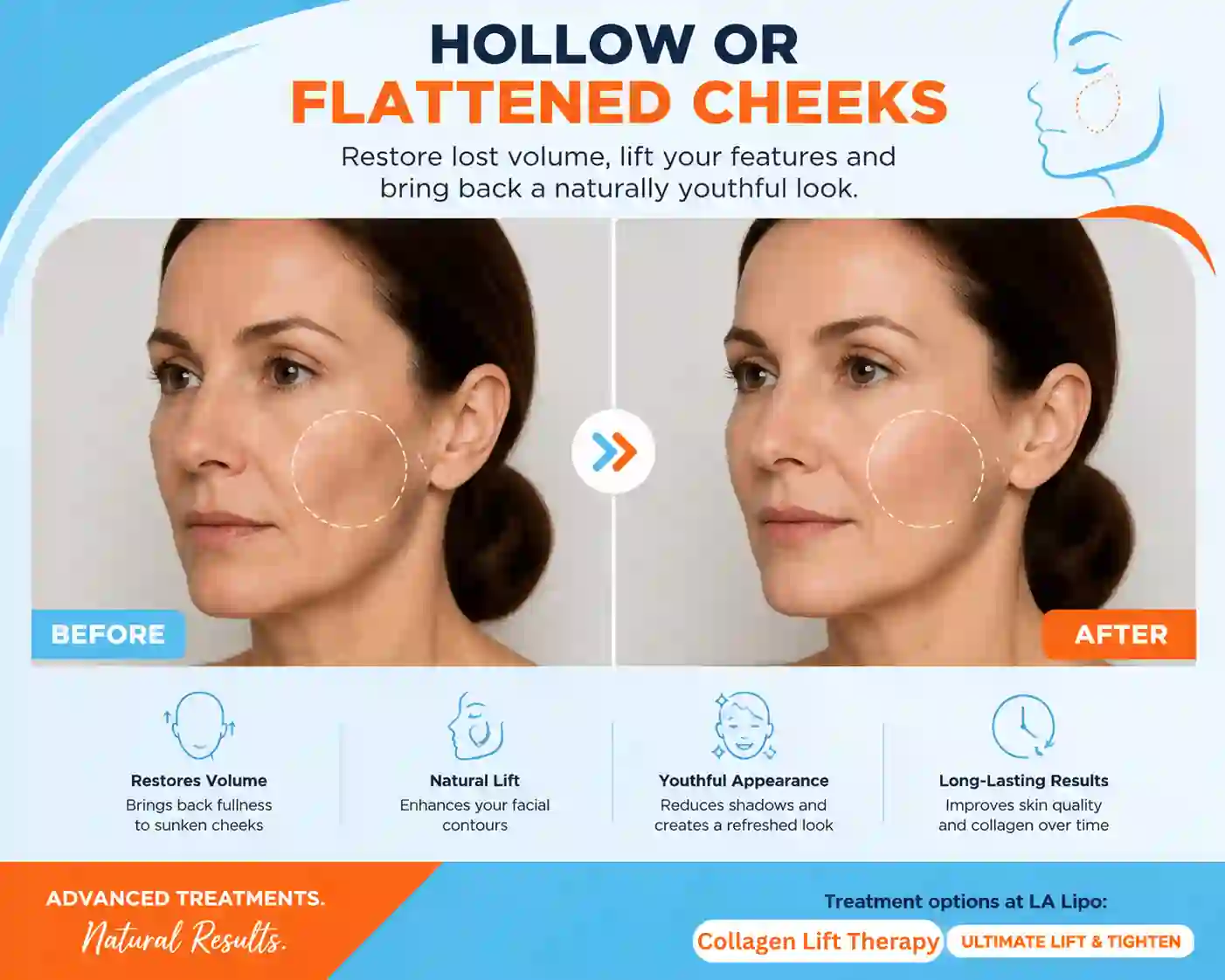 Sign #4: Hollow or Flattened Cheeks Bristol