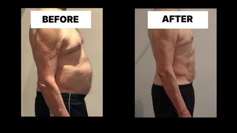 What Symptoms Can Diastasis Recti Cause in Men? Weak Core, Back Pain and Poor Posture Bristol